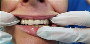 Bell Dent centar dentalne medicine PERIODONTICS
