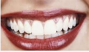 DentalTime d.o.o. za zdravstvenu djelatnost dentalne medicine TEETH WHITENING
