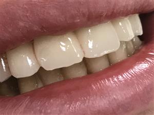 Bell Dent centar dentalne medicine TEETH WHITENING